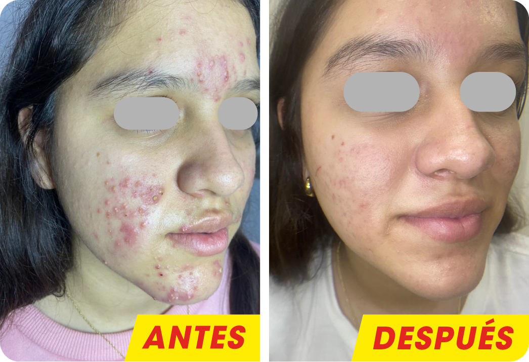 ACNÉ