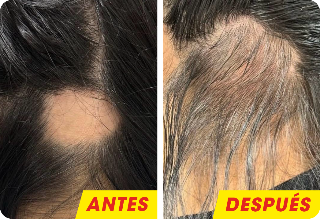 ALOPECIA