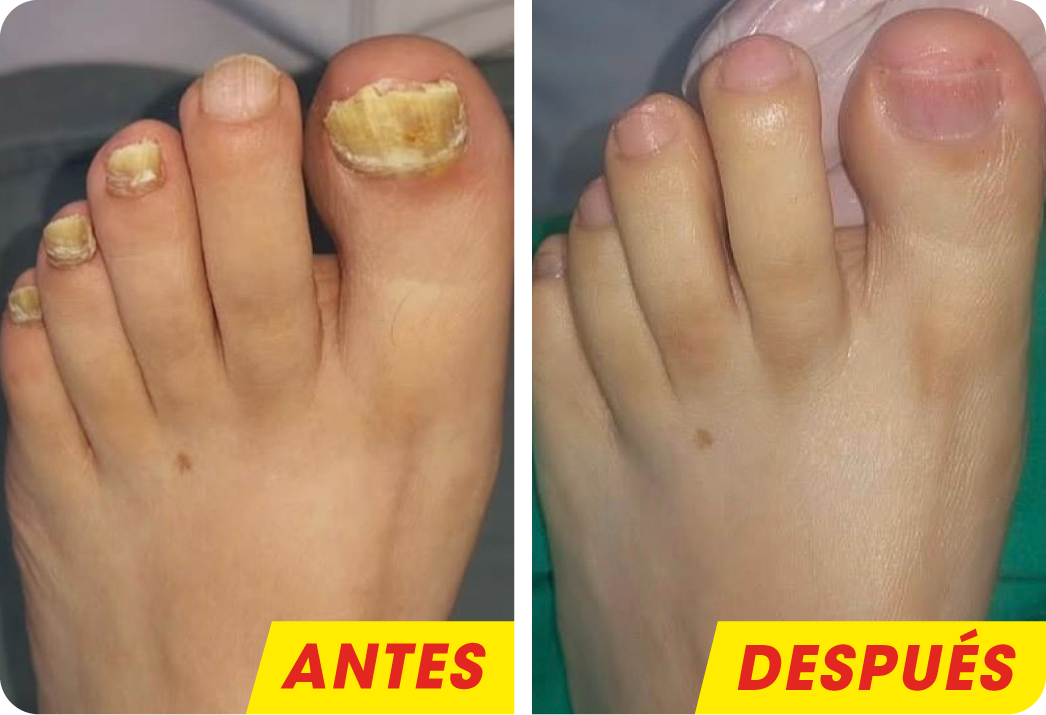 ONICOMICOSIS