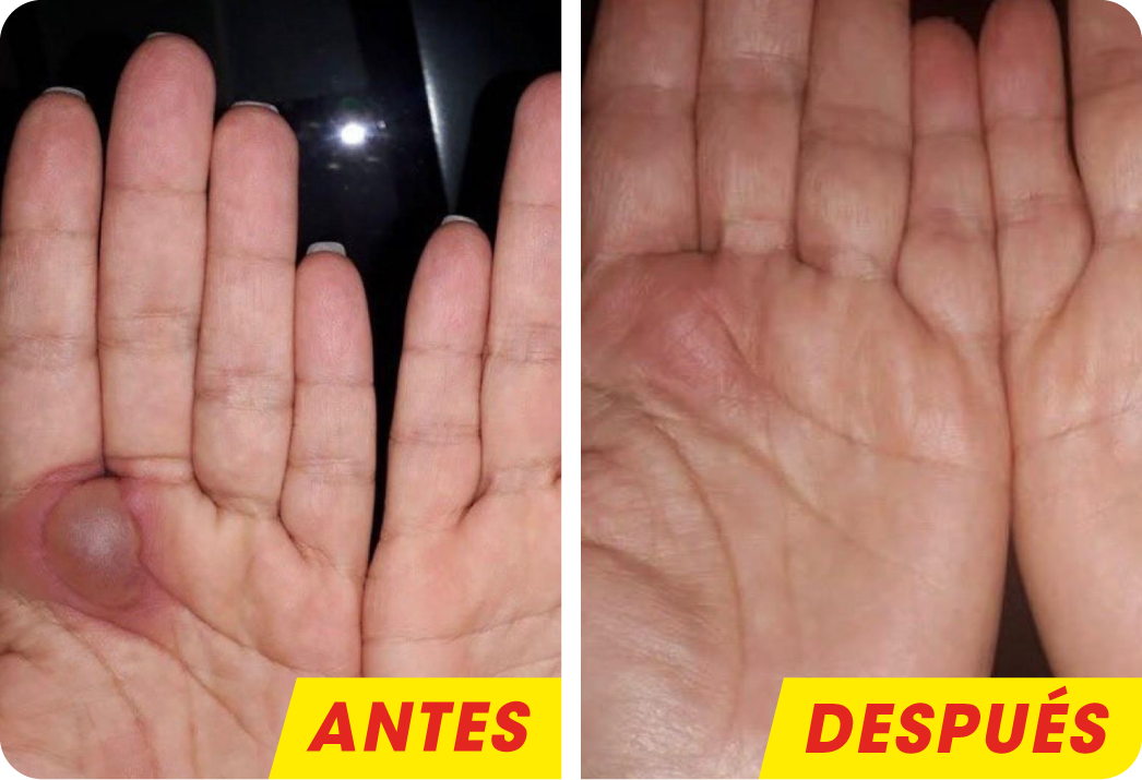 DERMATITIS CONTACTO