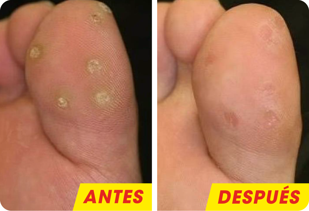 VERRUGA VIRAL